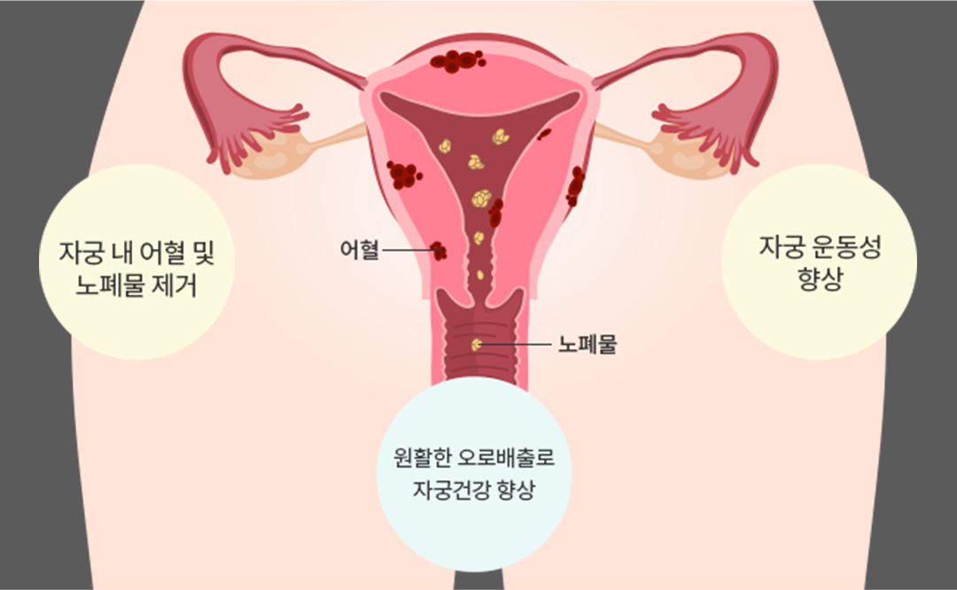 자궁 수축ㆍ노폐물 배출